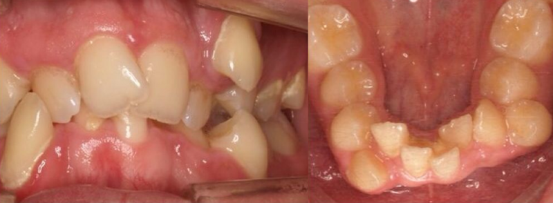 ortodoncia apiñamiento dental
